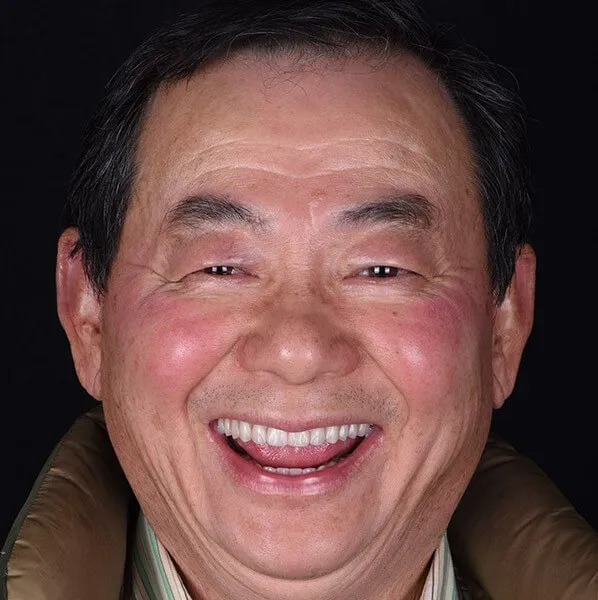 ALL ON 4 IMPLANTS