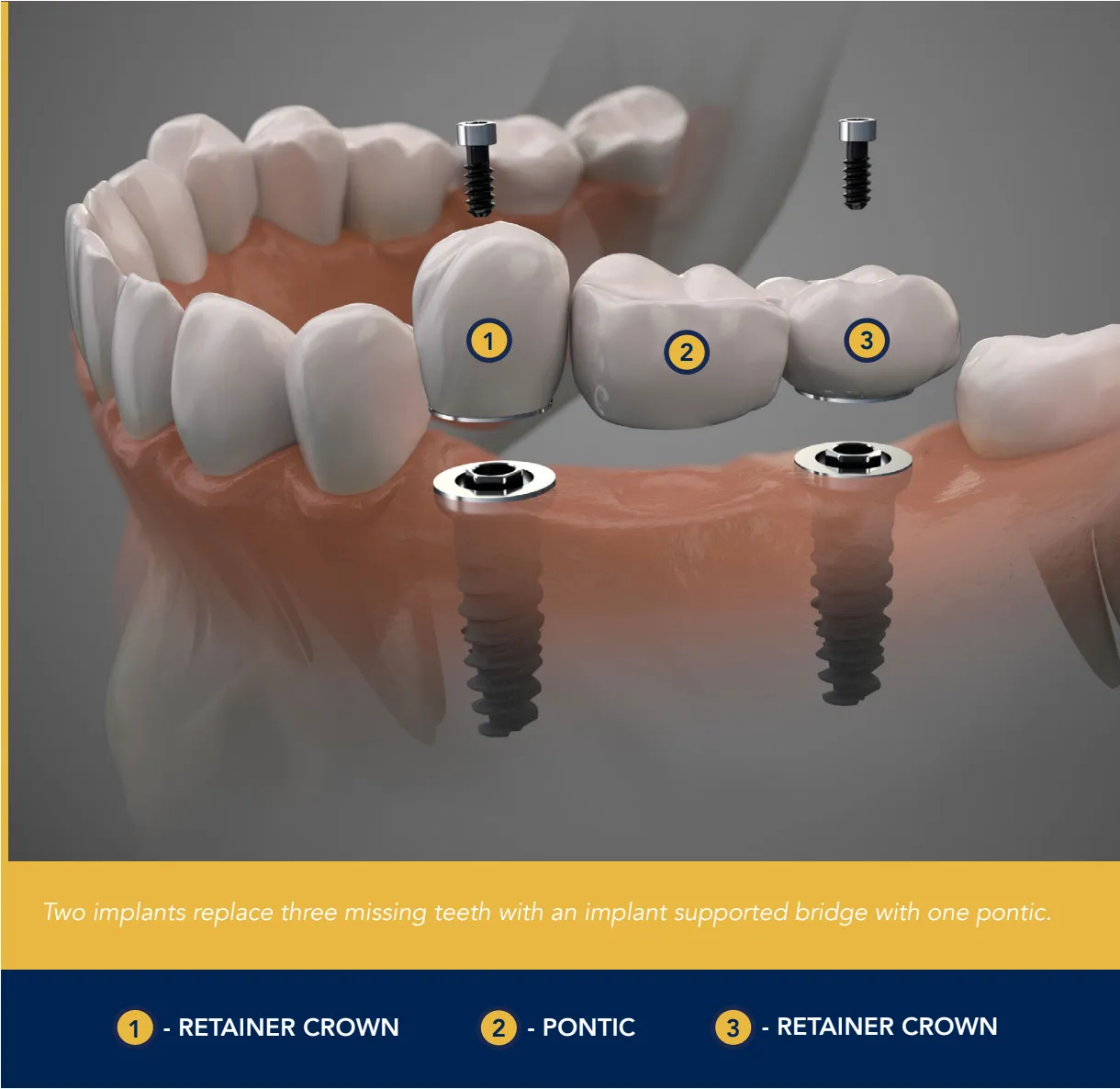 An implant bridge is used to replace several missing teeth in a row