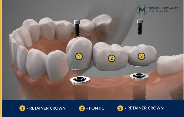 A tooth bridge of three teeth secured in place by two dental implants