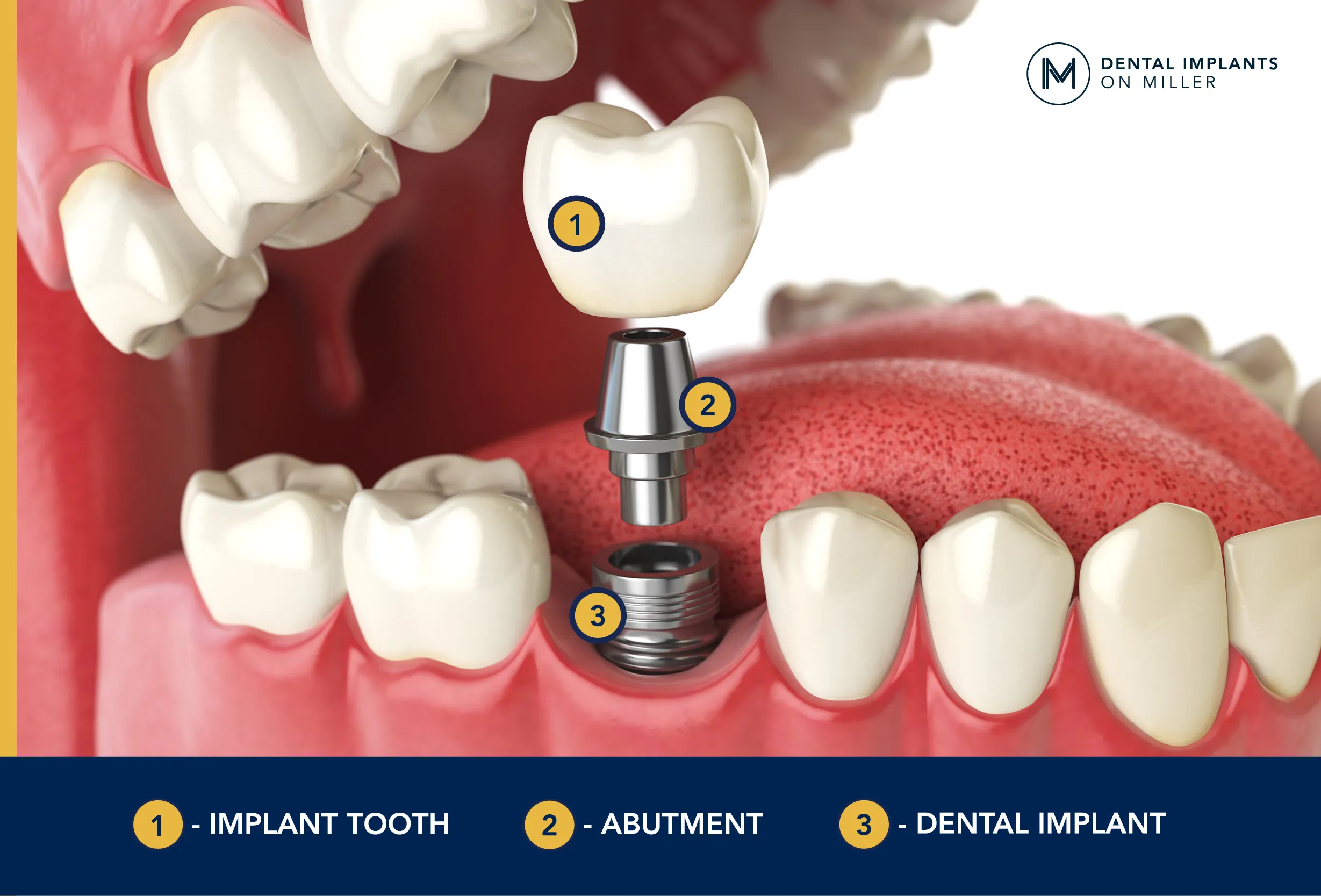 Single dental implant