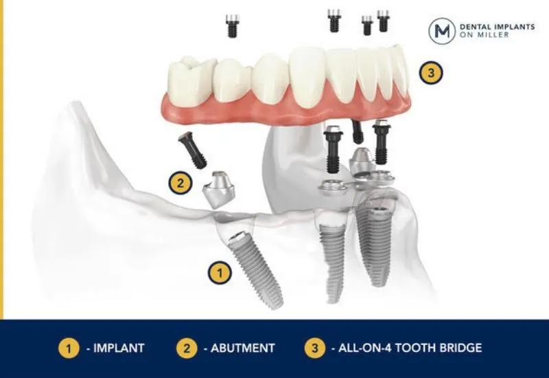 All-on-4 is used to replace missing teeth