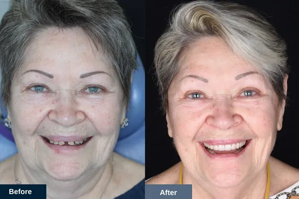 A Dental Implants on Miller patient before and after All on four dental implants