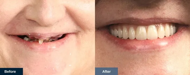A patient before and after All on 4 dental implants in the upper jaw