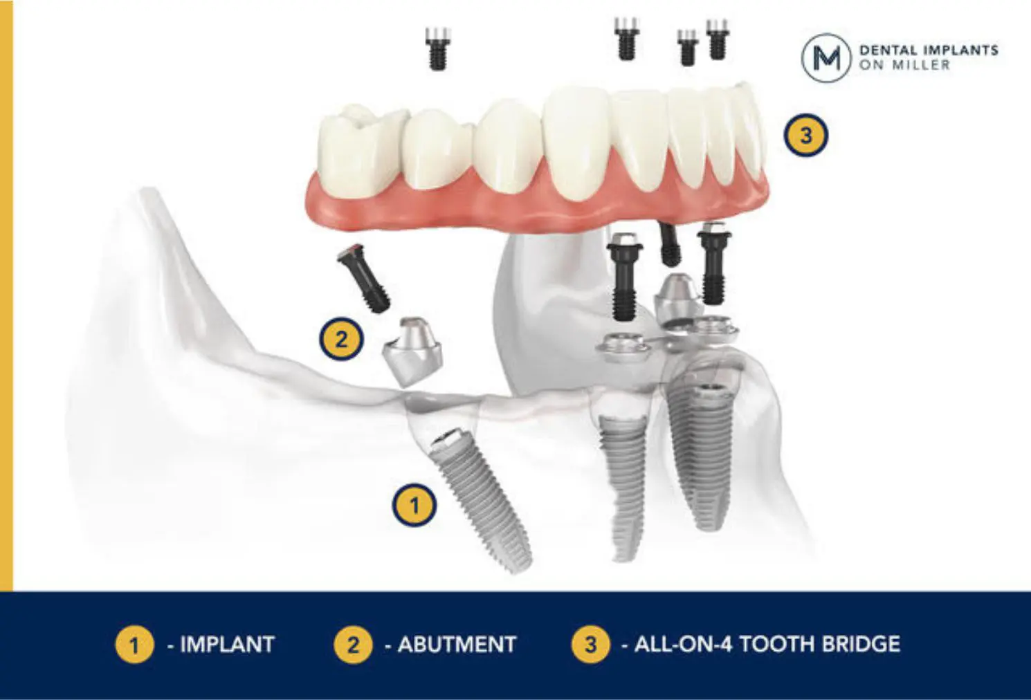 Cheapest all on 4 implants - 3 main elements