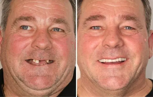 Before and after image of a patient that received all-on-4 treatment at Dental Implants on Miller. 