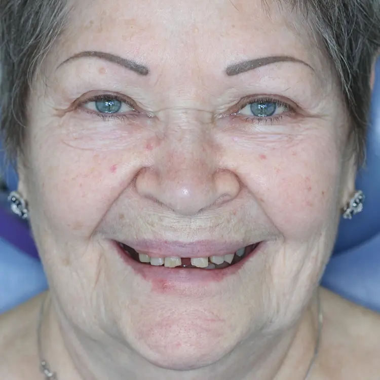 ALL ON 4 IMPLANTS