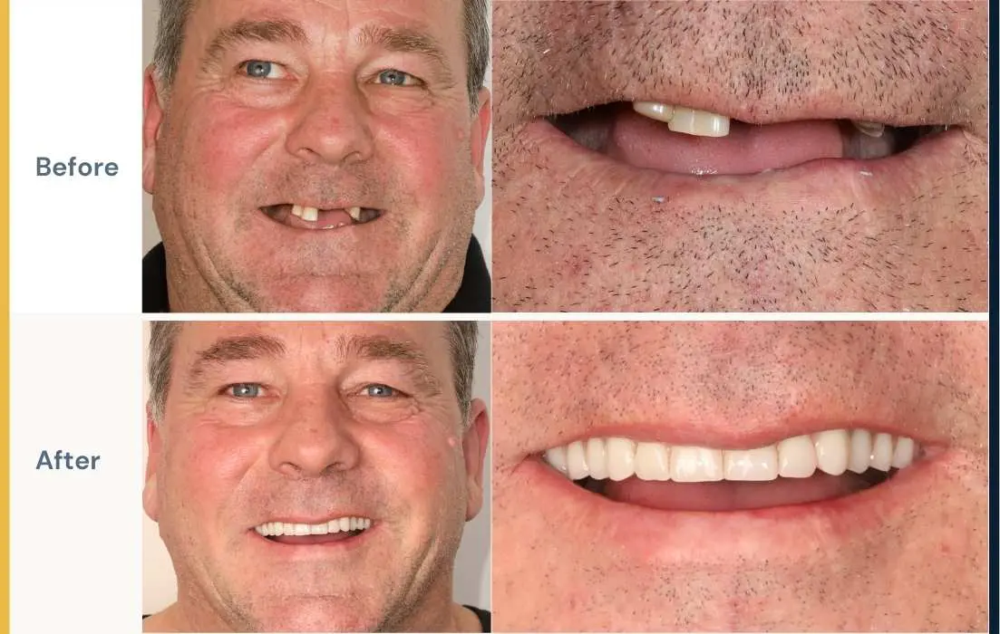 Before and after image of a male patient that received all-on-4 treatment at Dental Implants on Miller.