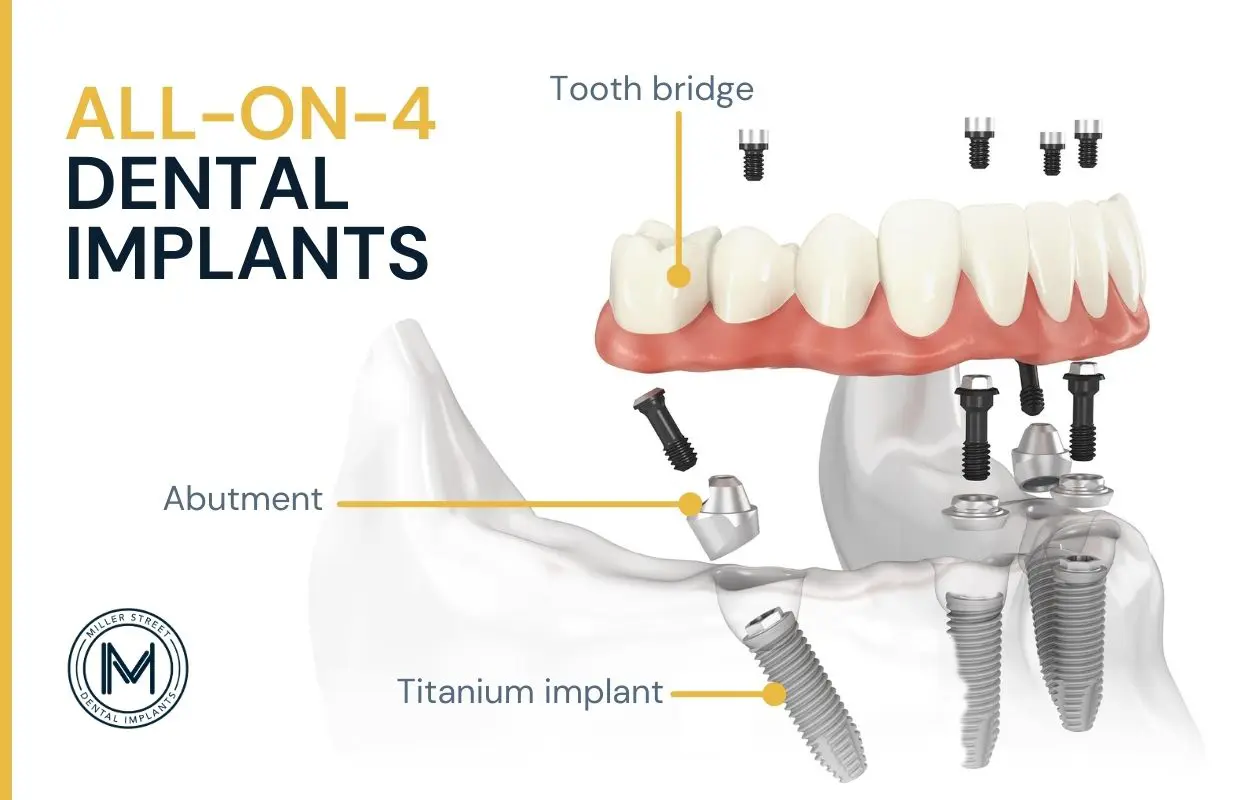 Illustration of an all-on-4 tooth bridge.