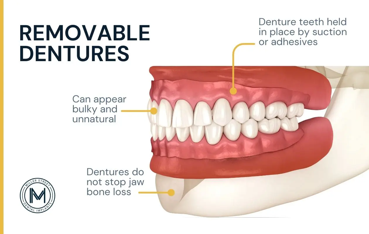 Illustration of removable dentures.