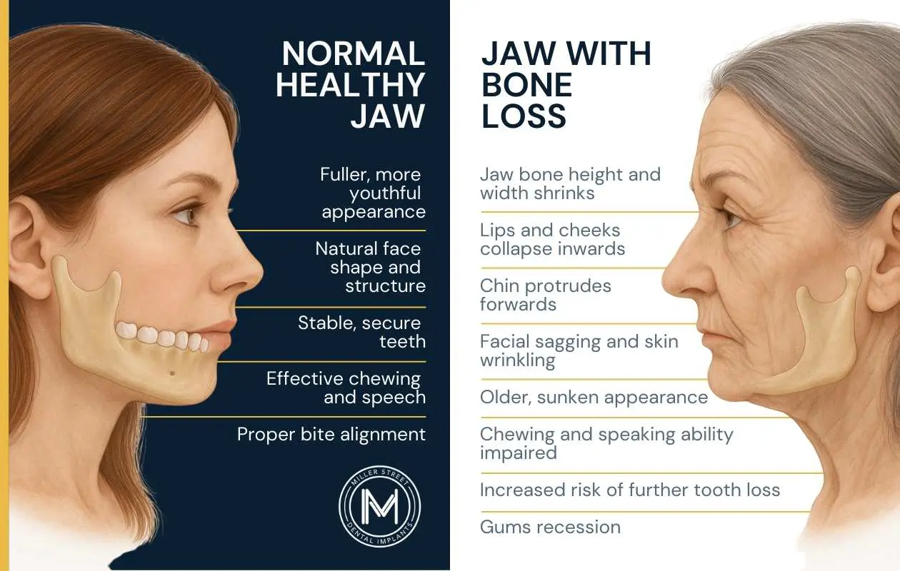 Differences between a normal healthy jaw and a jaw with bone loss.