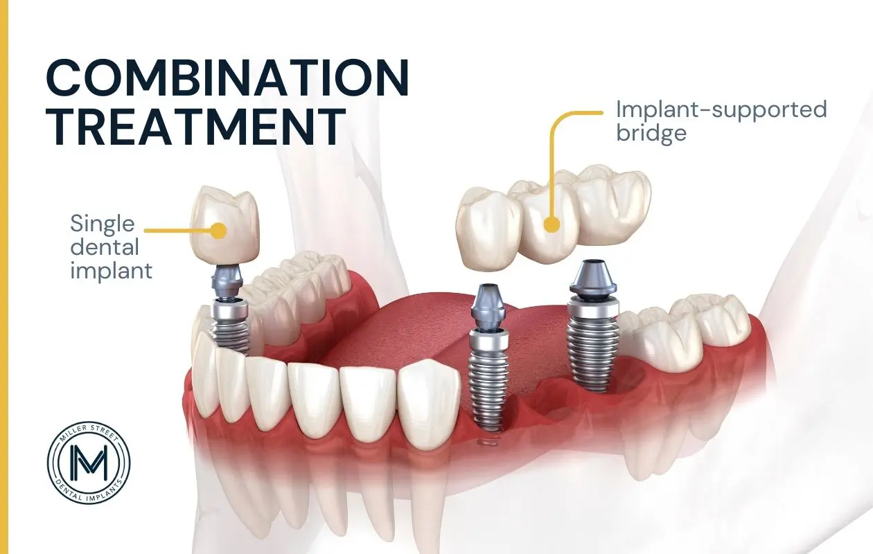 Illustration of a combination of treatments that include a single implant and an implant supported bridge.