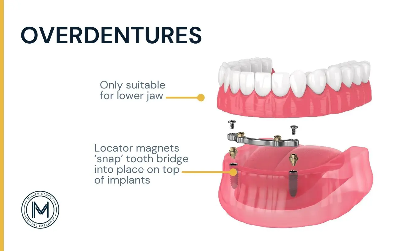 Illustration of an overdenture.