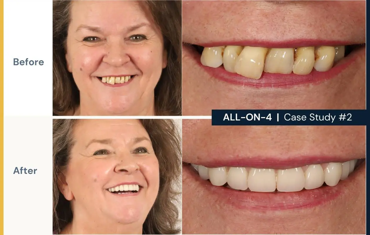 Before and after images of a female patient who had All on 4 dental implants treatment at Dental Implants on Miller.