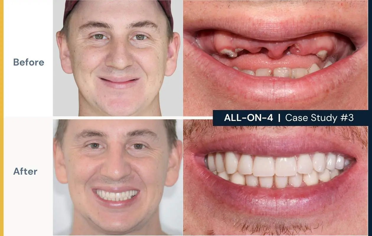 Before and after photos of a young patient who had All on 4 treatment at Dental Implants on Miller.