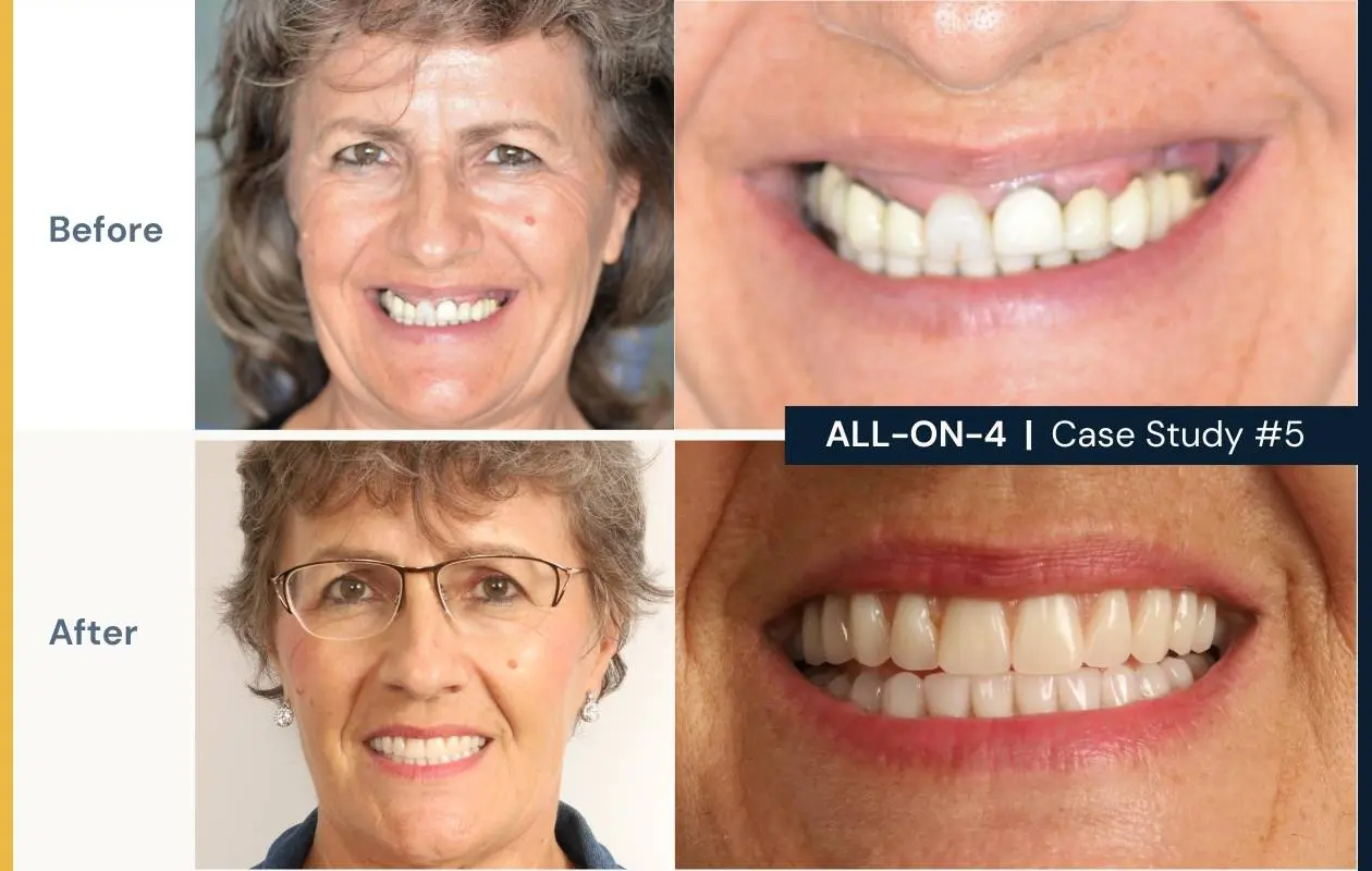 Before and after image of a patient who received all-on-4 treatment at Dental Implants on Miller. 