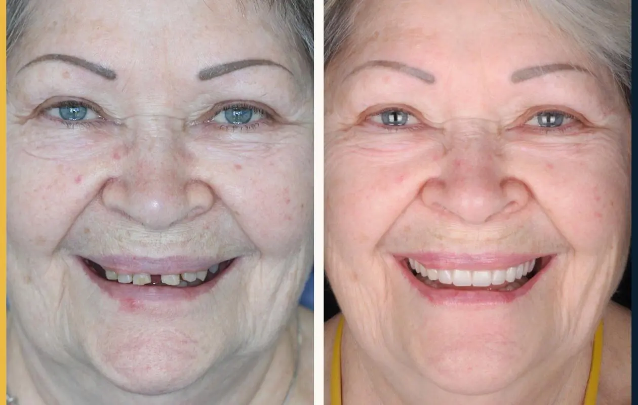 Before and after photos of a female patient who received all-on-4 implants at Dental Implants On Miller.