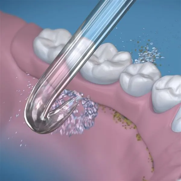 A water flosser being used to clean between the gums and tooth bridge.