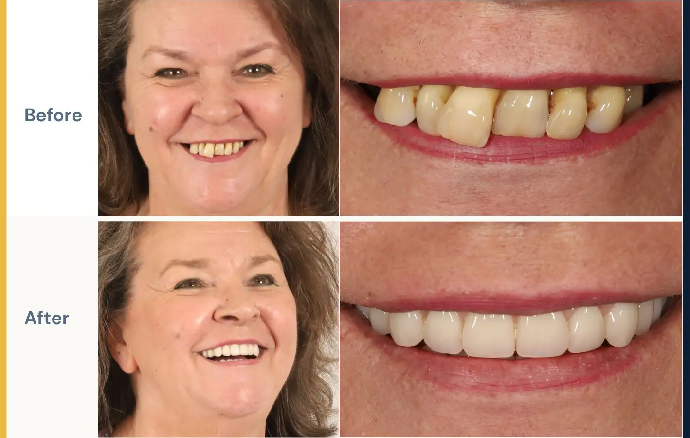 Before and after photos of a female patient that received All-on-4 treatment at Dental Implants on Miller.