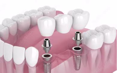 implant bridge