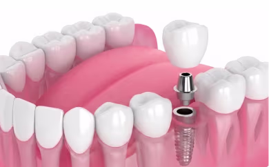 Single Implant