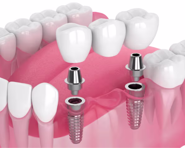 implant bridge