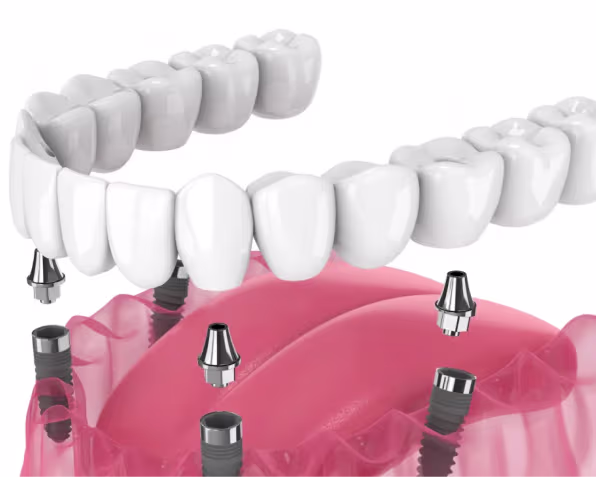 Full Mouth Dental Implants Cost