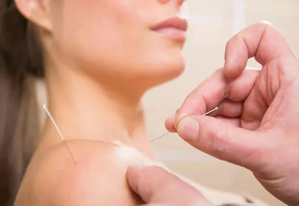Dry Needling