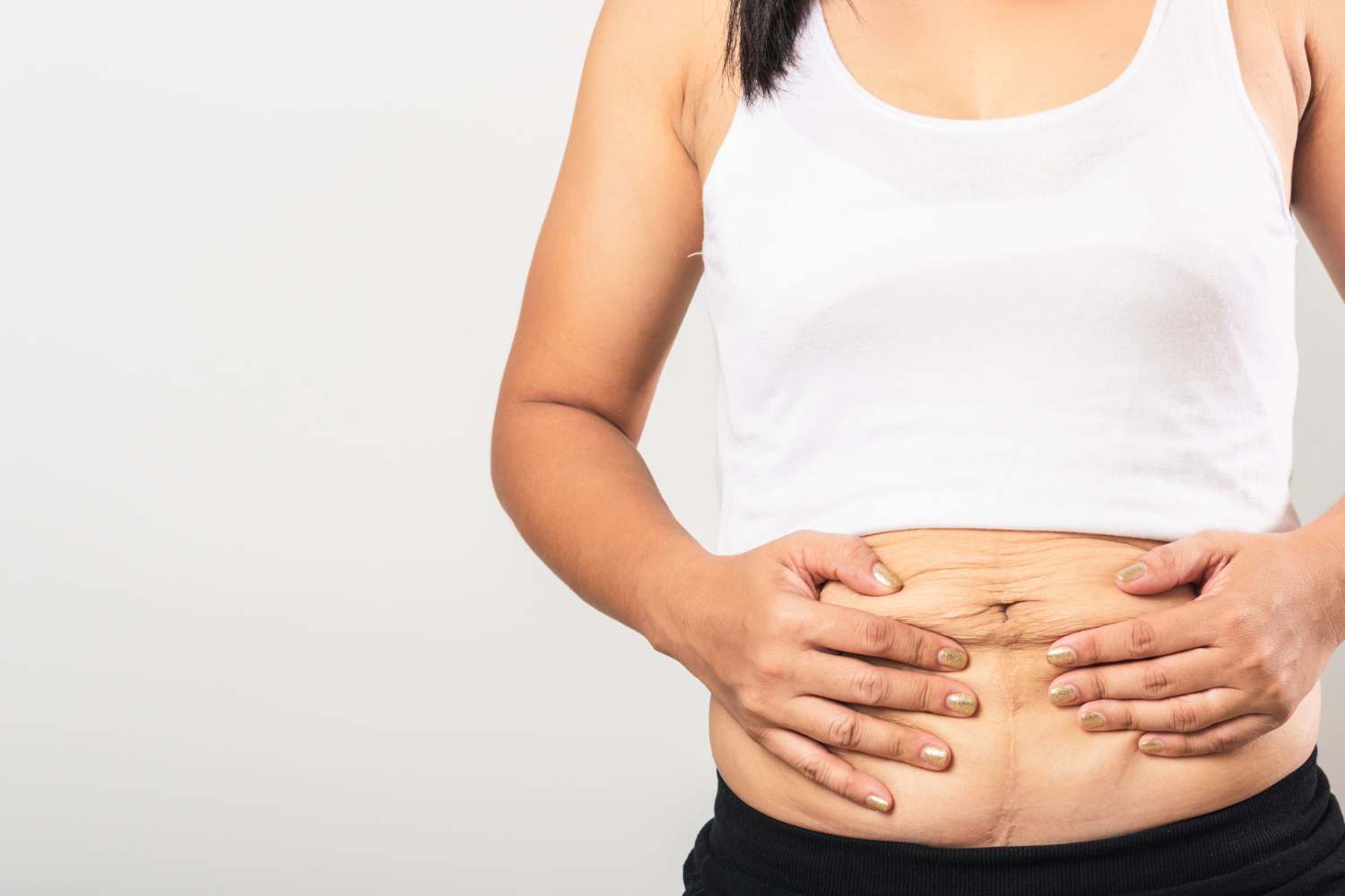 Woman holding postpartum belly wrinkles.