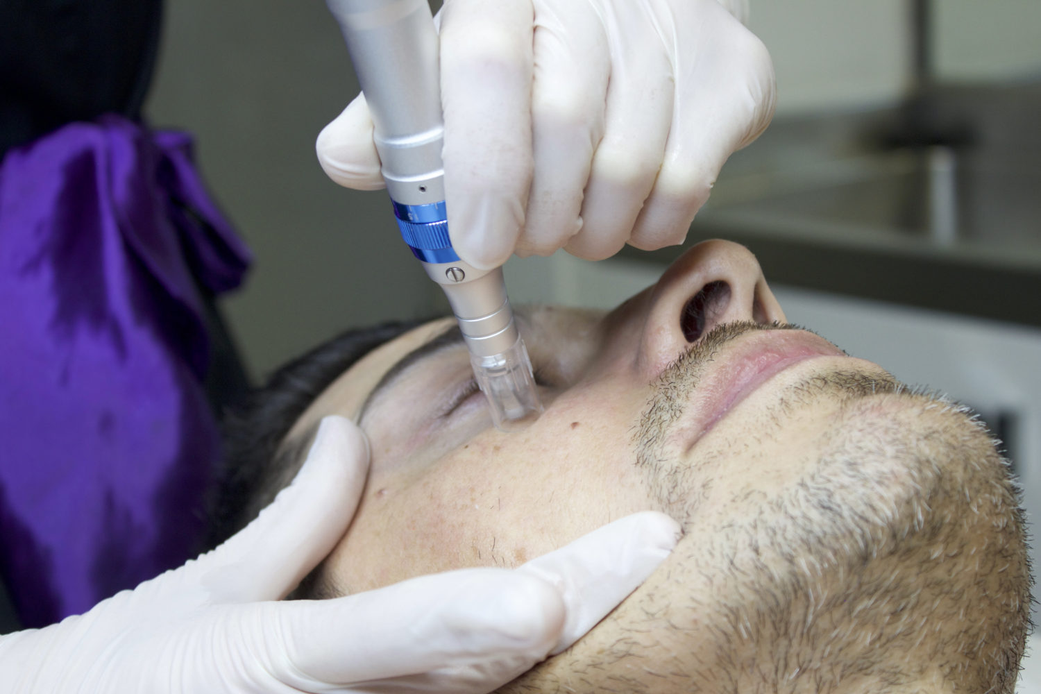Man receiving microneedling facial treatment.
