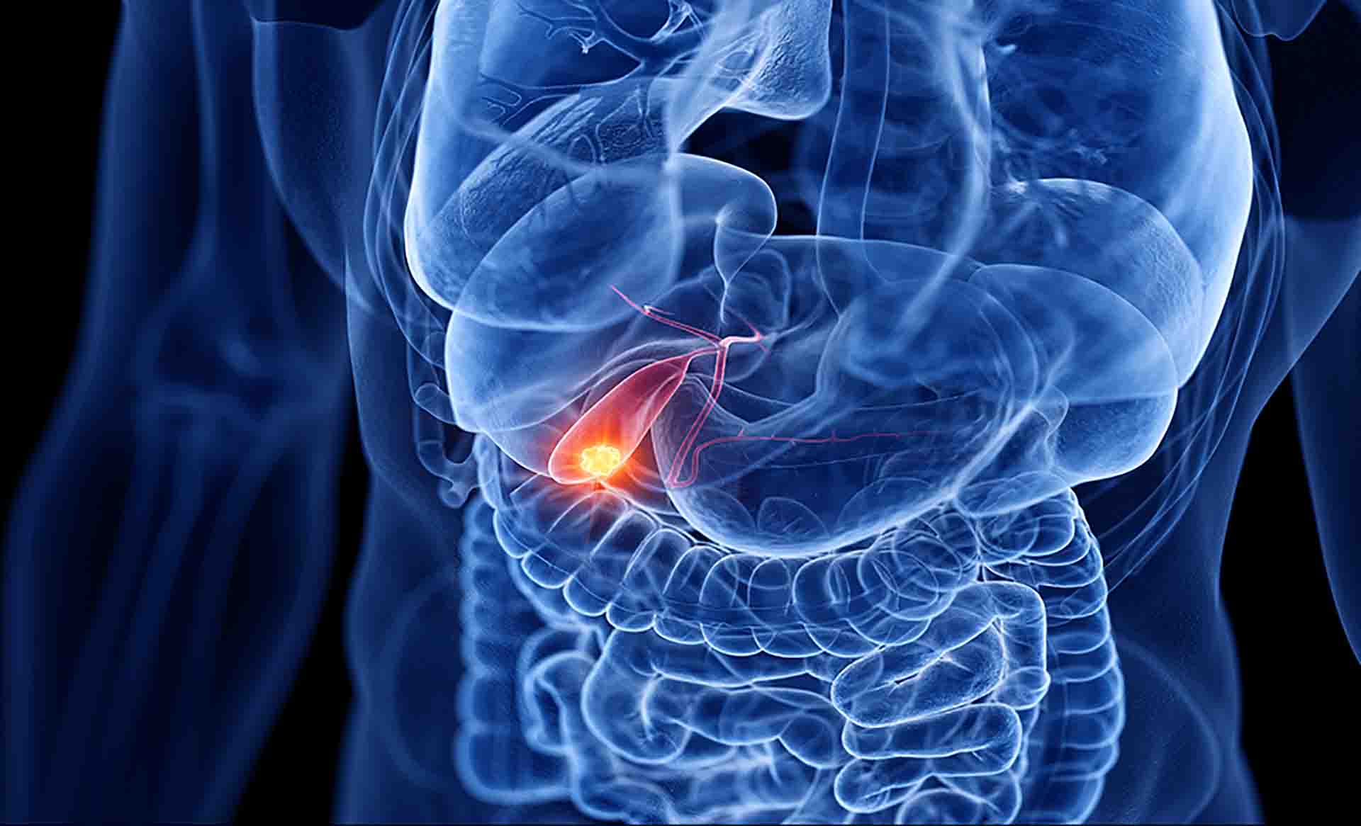 Colecistite aguda: o que estudar para a prova?