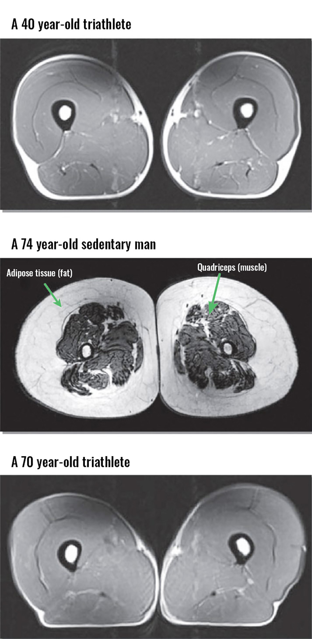 Cross section of the thighs of a 40 year-old triathlete, a 74 year-old sedentary man and a 70 year-old triathlete