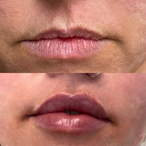 Restylane Kysse Immediate Before and After