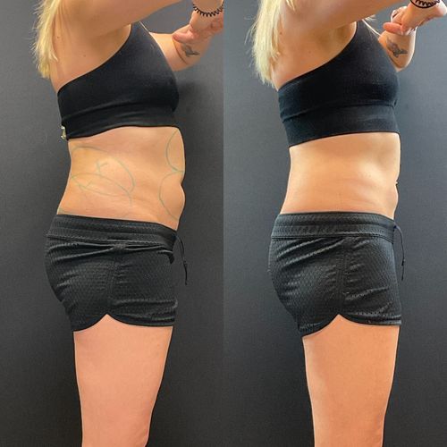 Coolsculpting Before and After Abdomen and Flanks
