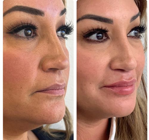 Sculptra and Restylane Kysse Before and After Right View