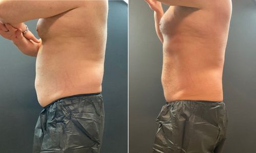 Before and After 1 Coolsculpting Elite Treatment Male Abdomen