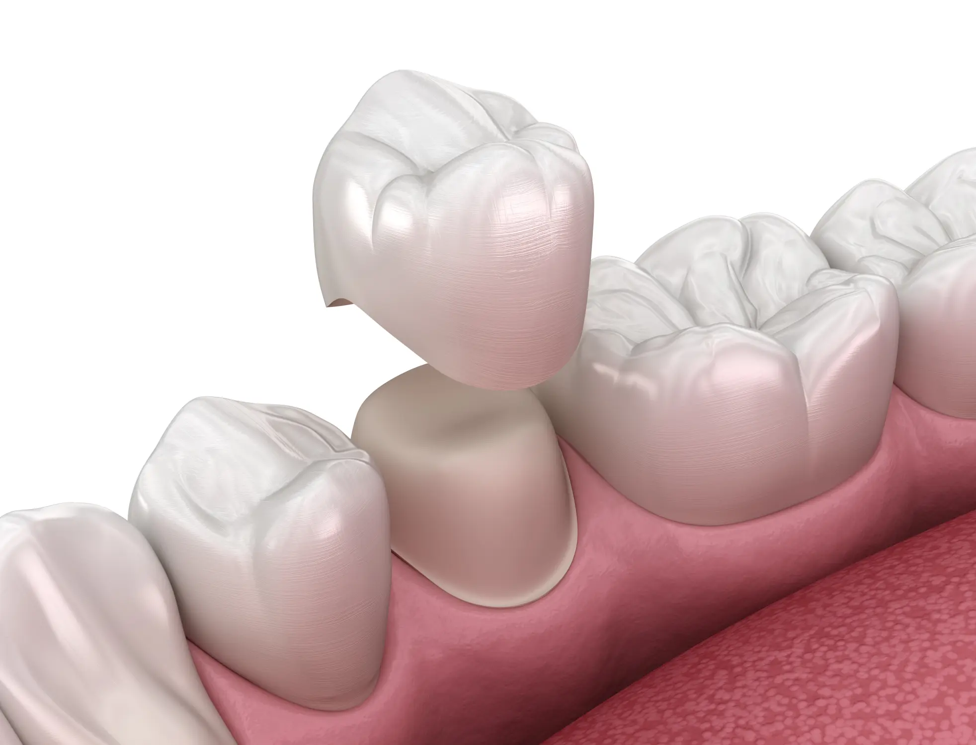Zirconia, Gold, or Porcelain? Choosing the Best Crown Material for Your Back Teeth vs. Front Teeth