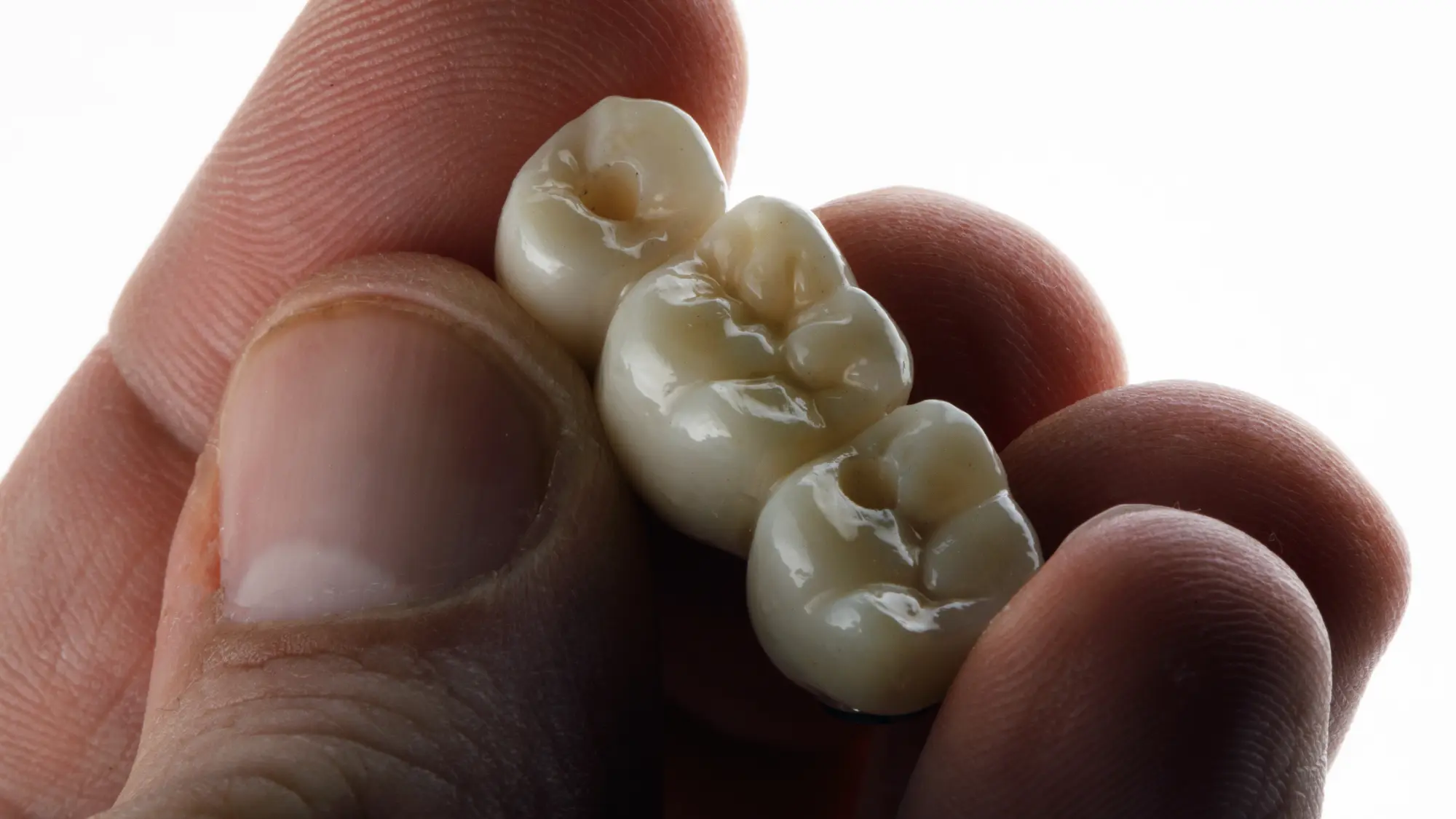 Dental Bridge vs. Implant: Which is Best for Replacing One Tooth?