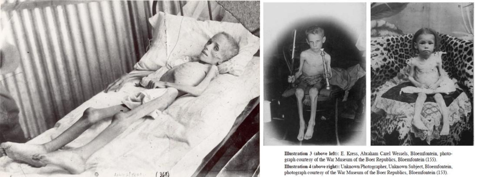 Black and white photos of three severely malnourished children in different settings.