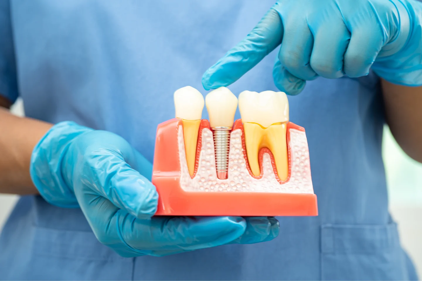 Prevent bone loss dental implants