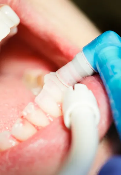 Preventive dentist in Secaucus | Preventive dental care services