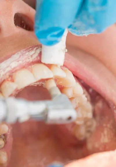 Dental cleaning in Secaucus