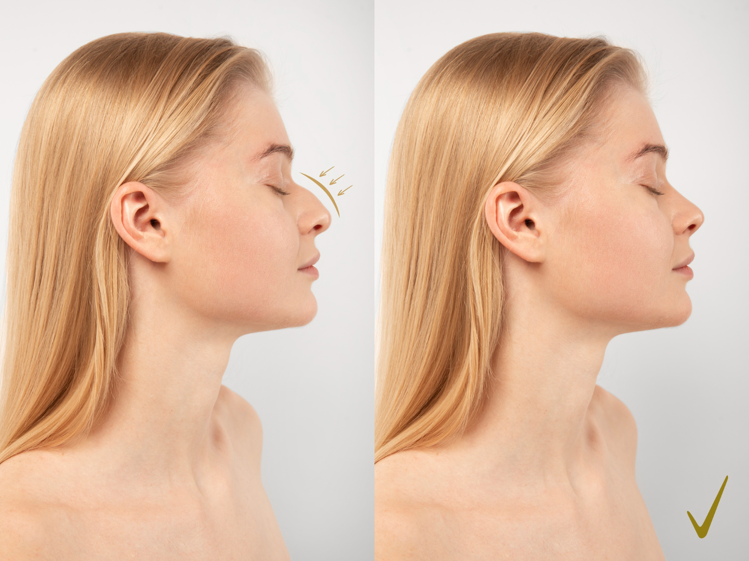 Rhinoplasty in Dubai for Wide Nose: Procedure, Cost & Recovery Guide