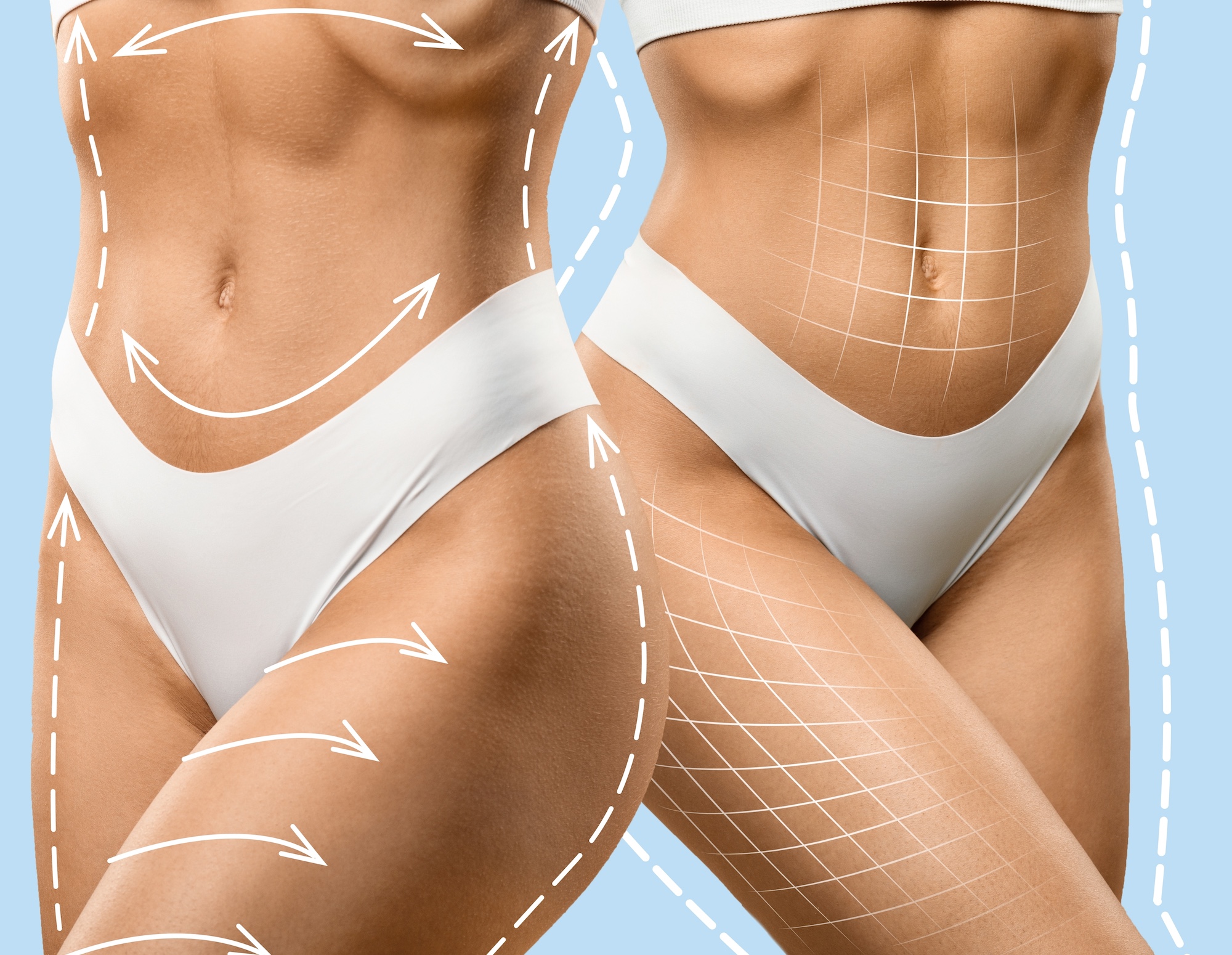 Liposuction in Dubai: What to Expect During Recovery & Tips