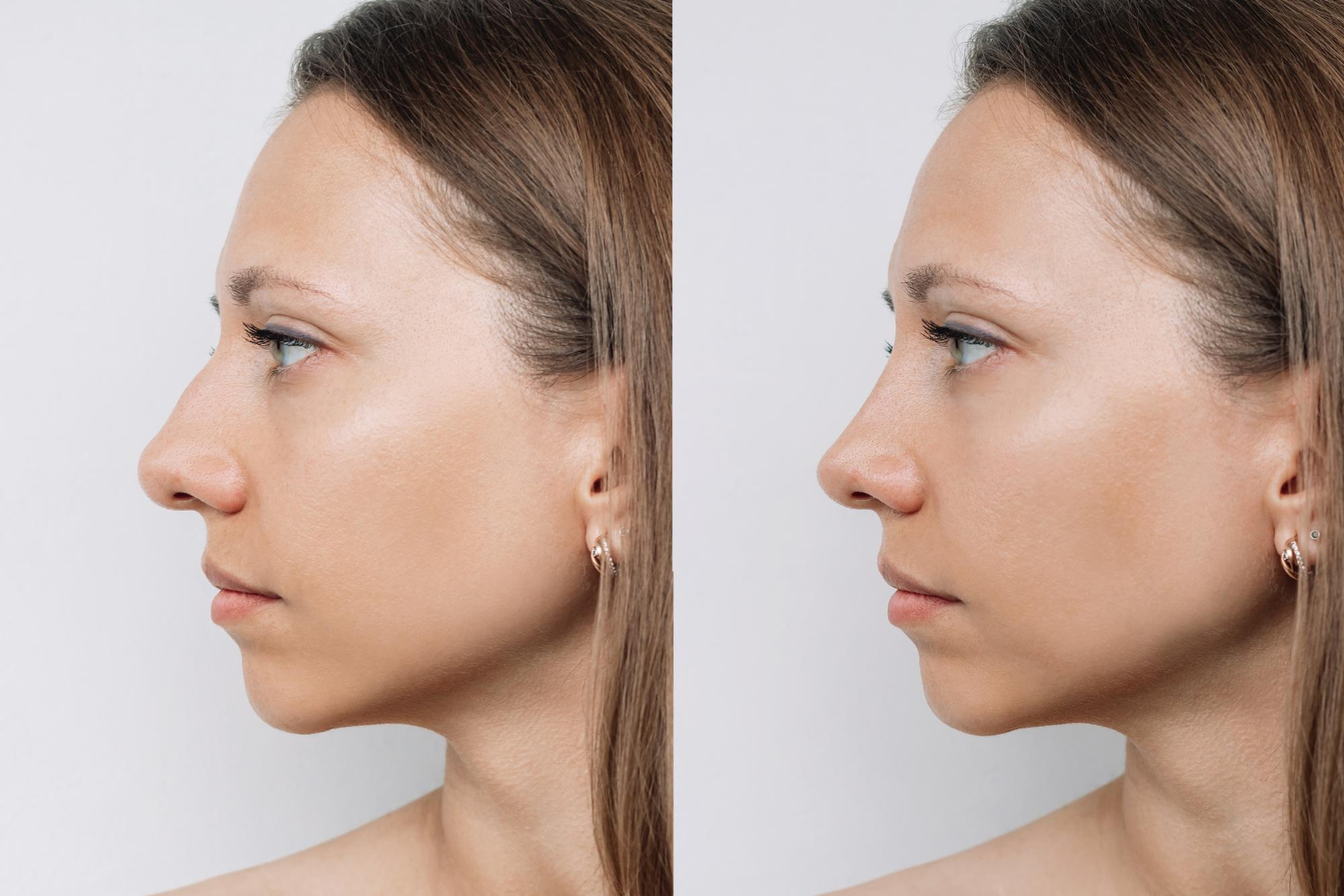 Rhinoplasty in Dubai: Thick vs Thin Skin Explained