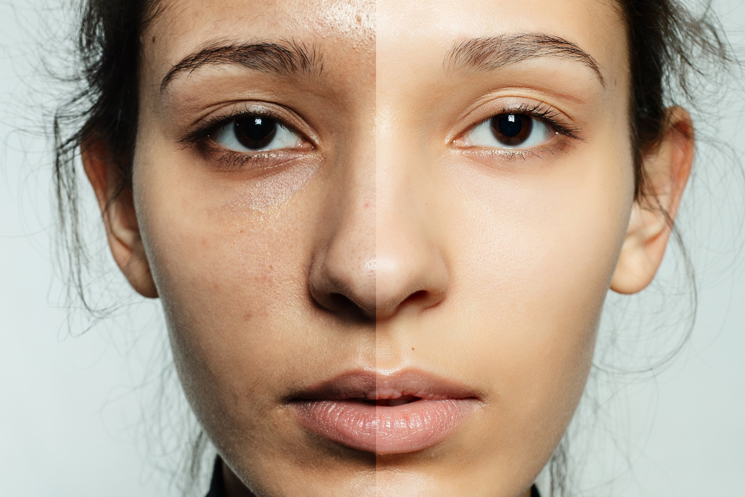 Melasma & Hyperpigmentation in Gulf Skin: A Safe Protocol That Actually Works