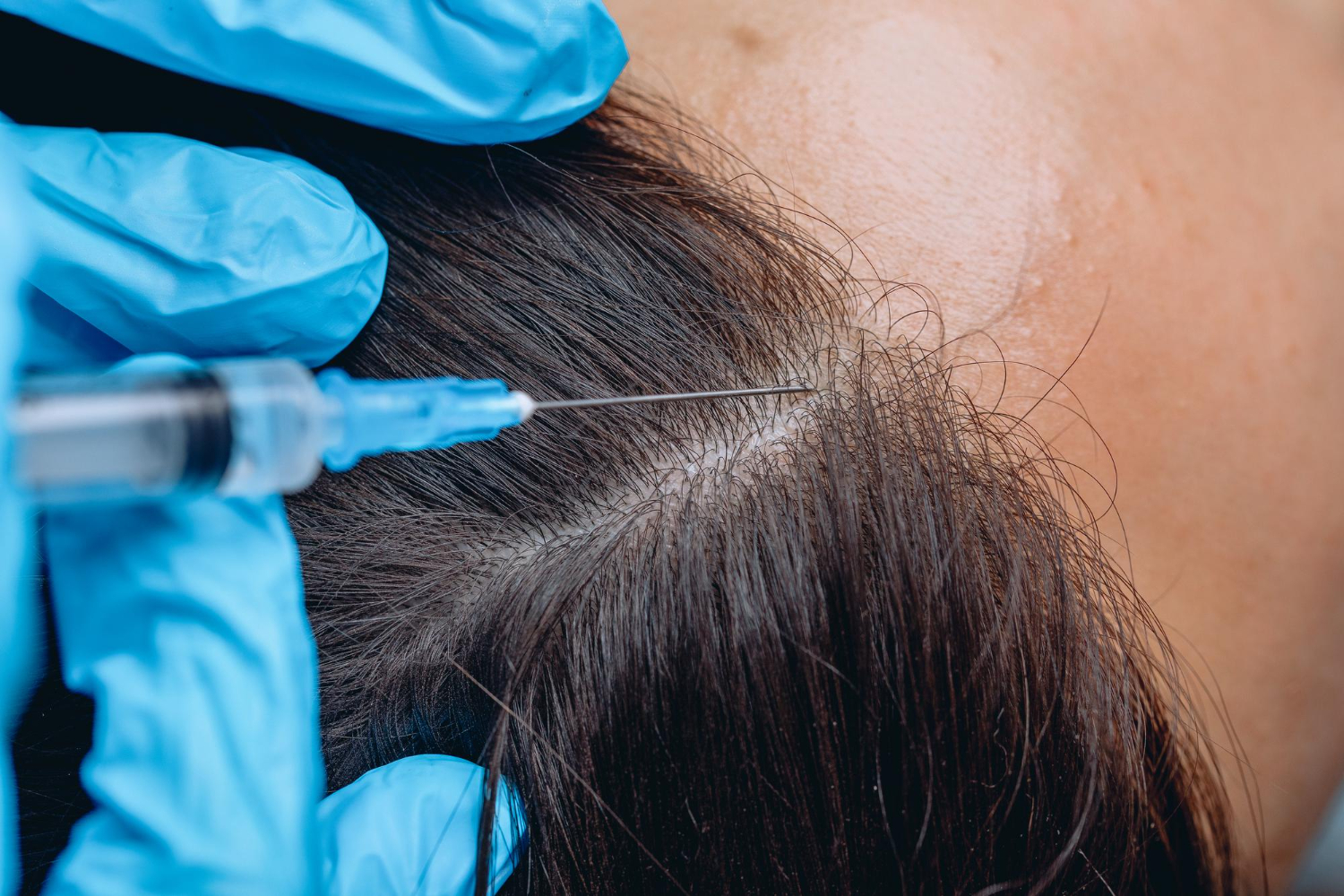 Hair Restoration & Scalp Longevity in Dubai: PRP, Exosome-Adjacency & Medical Programs