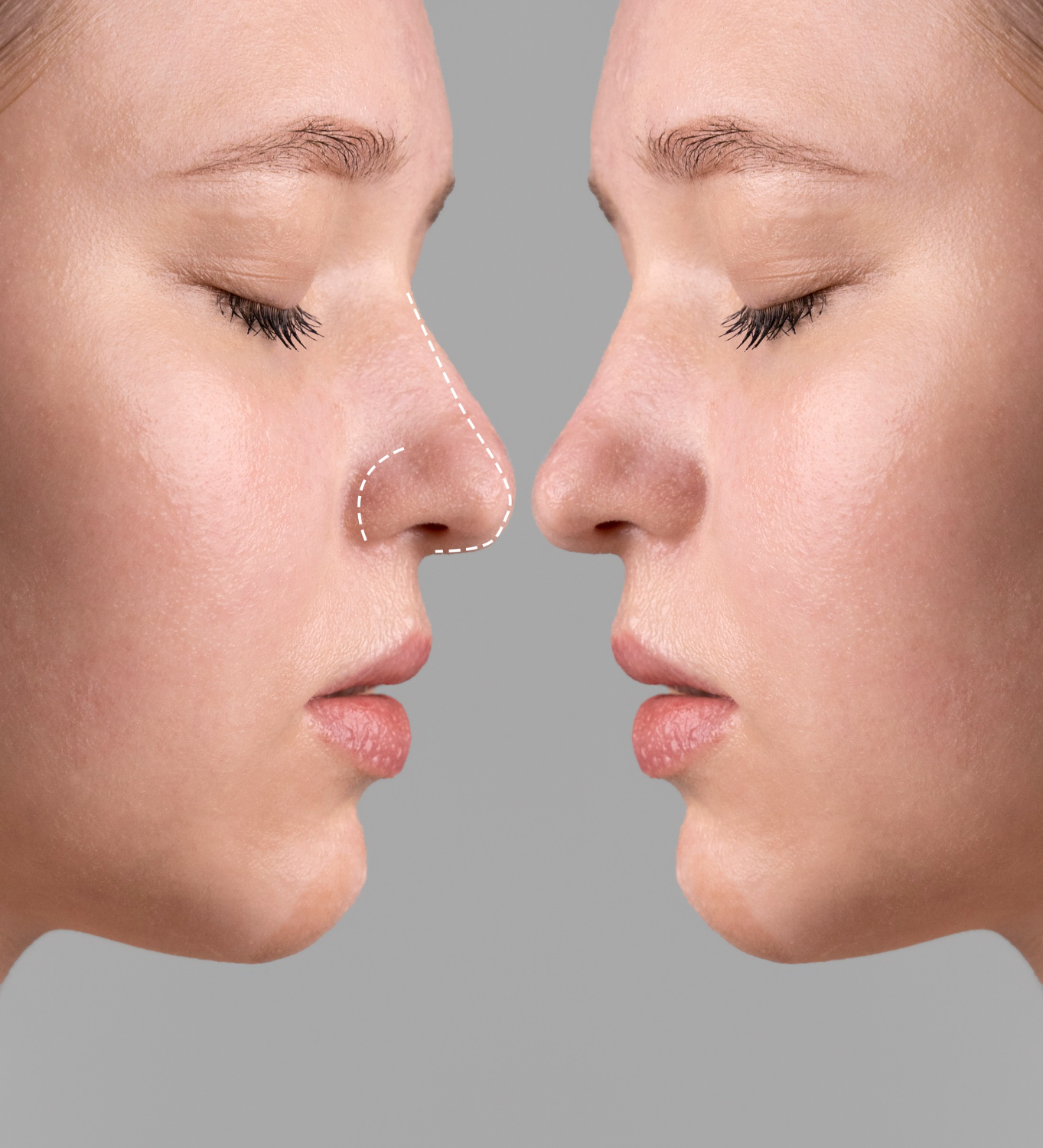 Rhinoplasty in Dubai – 10 Tips for Faster Recovery