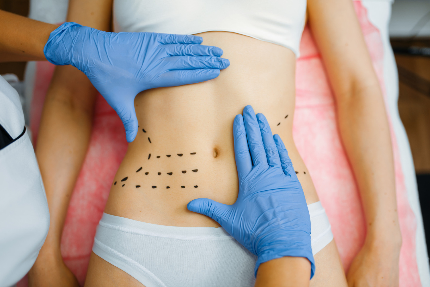 Ultimate Tummy Tuck Guide