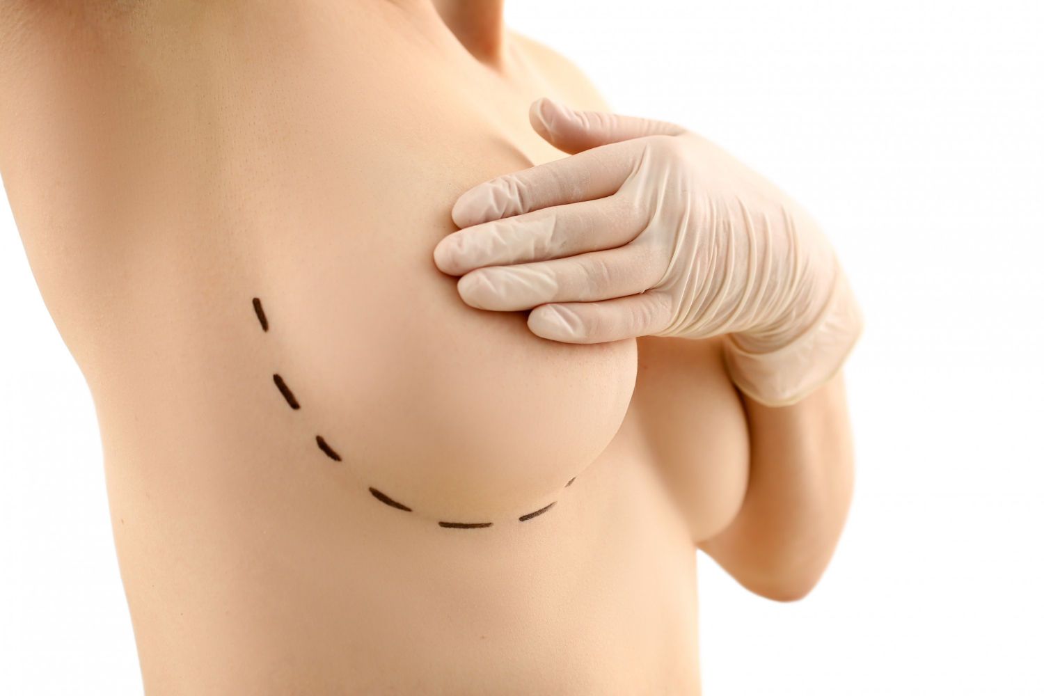 What Are The Types Of Breast Lifts Available?
