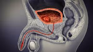 Rak mehurja in transuretralna resekcija v mehurju
